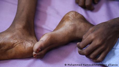 عرب دنیا میں بھوک بڑھ رہی ہے، اقوام متحدہ