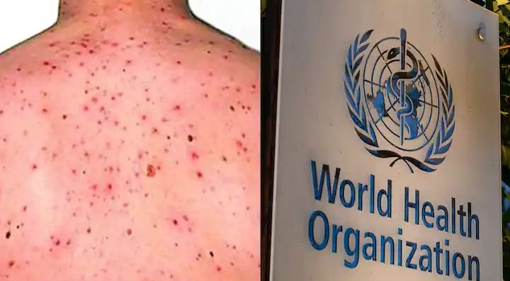 منکی پاکس کے پس منظر میں عالمی صحت ہنگامی حالات نہیں: ڈبلیو ایچ او