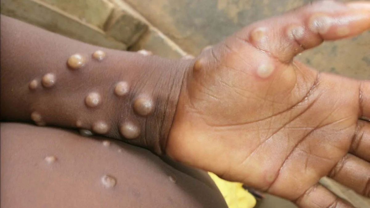 Monkeypox: केरल में मंकीपॉक्स का एक और नया मामला
