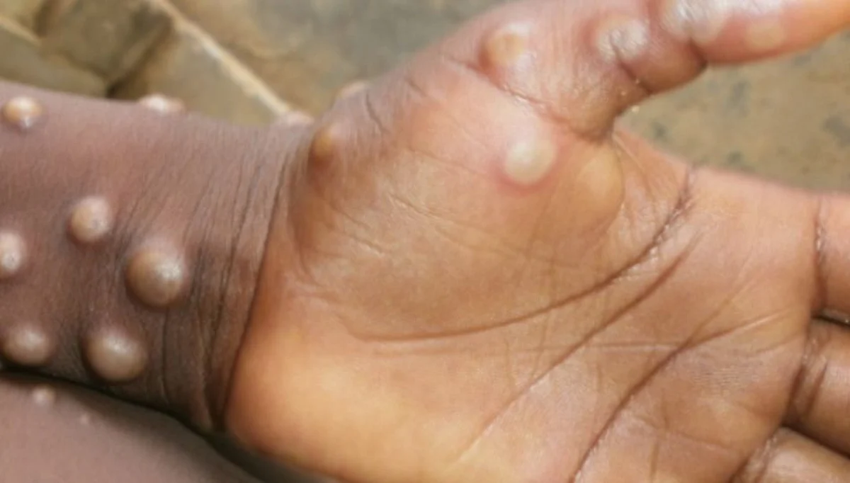 Monkeypox