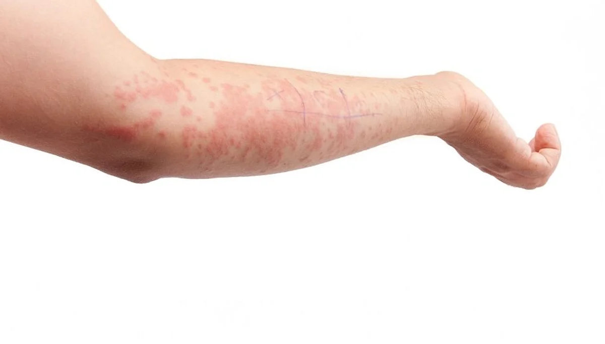 Skin Allergies: पावसाळ्यातील त्वचेच्या अॅलर्जीसाठी घ्या अशी काळजी