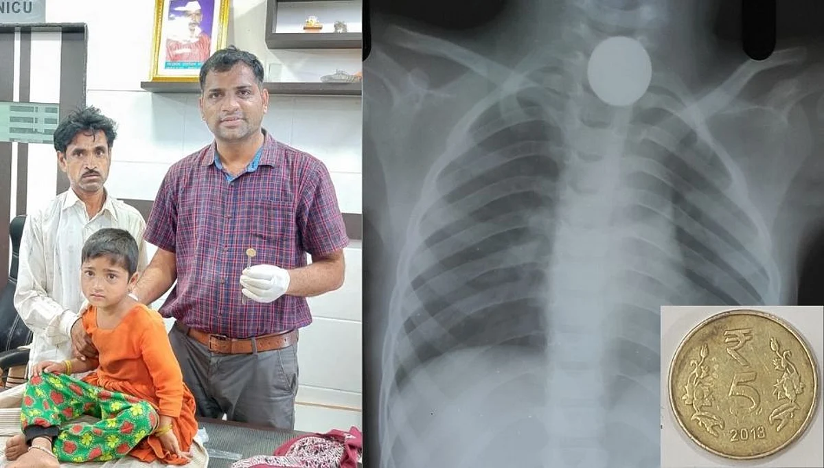 सहा वर्षीय चिमुकलीच्या घशात नाणं अडकलं; डॉक्टरांनी विनाशस्त्रक्रिया काढलं...