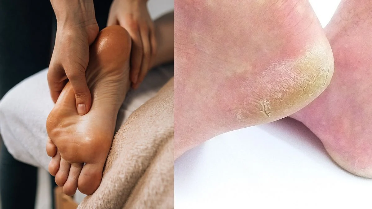 Skin Care : भेगा पडलेल्या टाचांपासून अशी मिळवा सुटका!