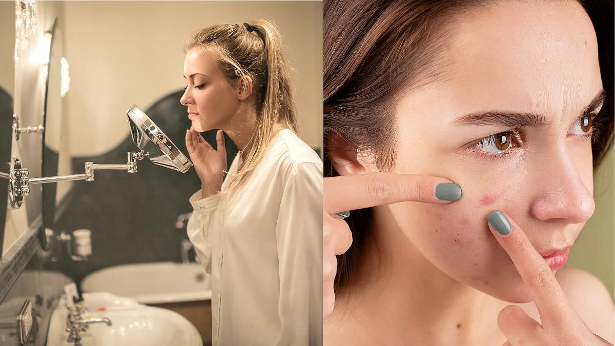 Skin Care : मुरुमांपासून तुम्ही देखील त्रस्त आहात तर; हे उपाय करुन पहा.