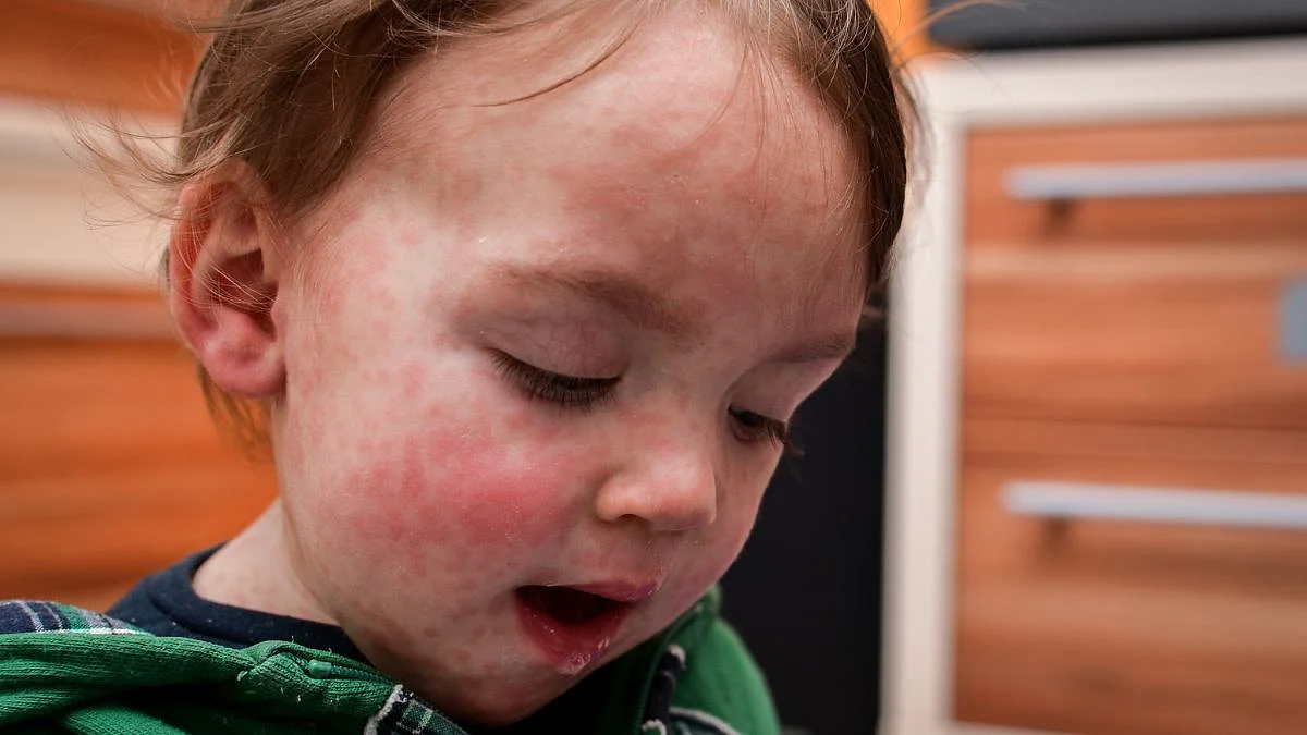 Measles Disease