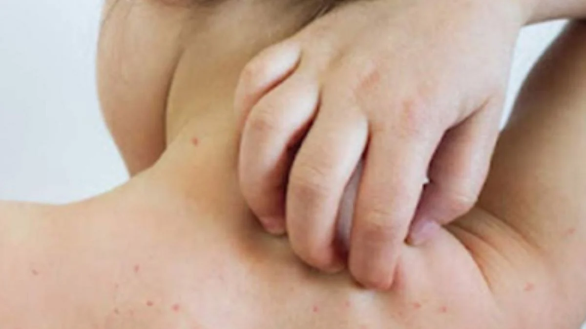 Mumbai Measles