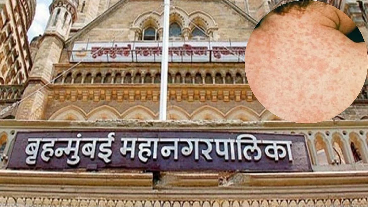 Measles Disease In Mumbai