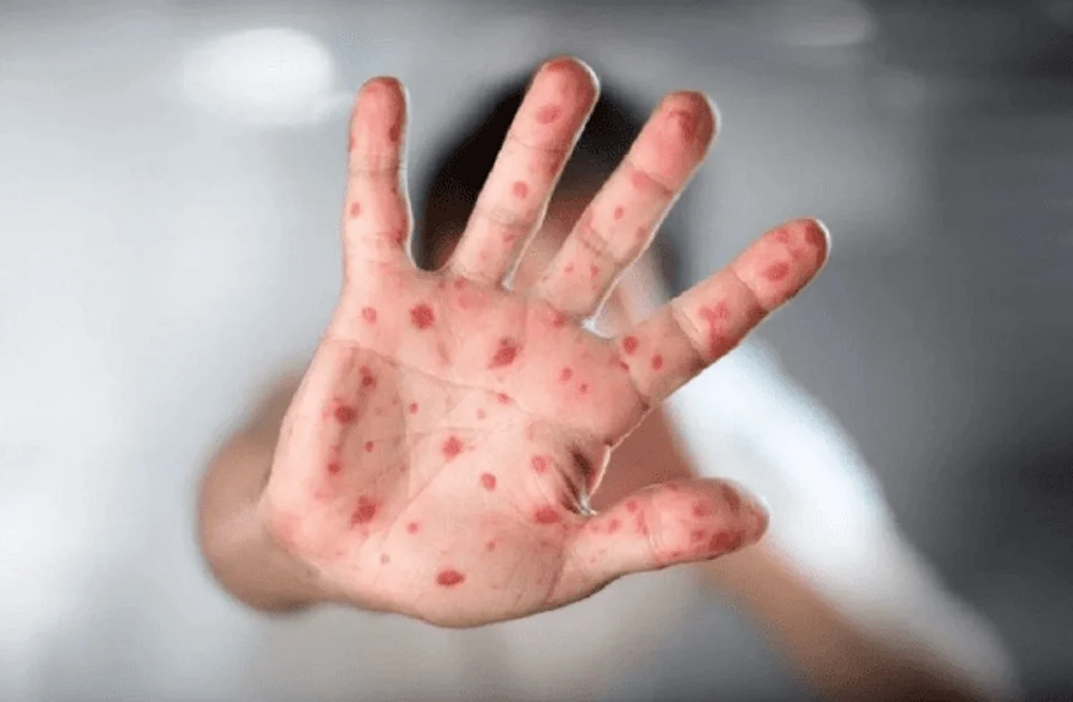 إنجلترا تسجِّل 18 إصابةً جديدةً بـ "جدري القرود"