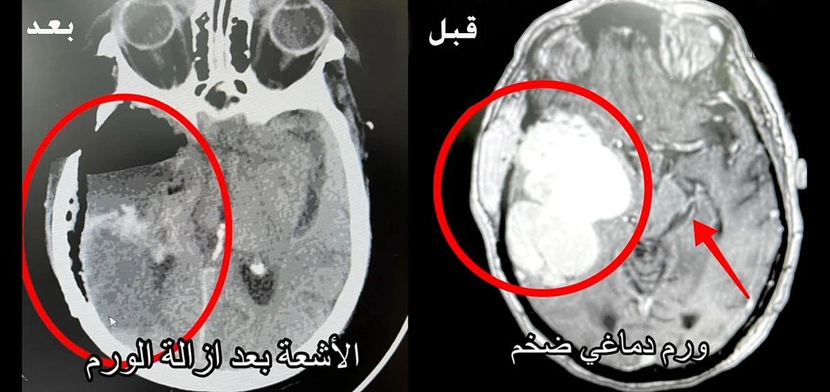 ورم دماغي