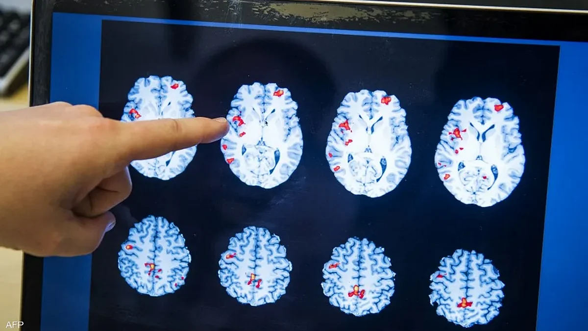 أصيب بها 381 شخصًا في العالم.. دولة آسيوية تسجل إصابة بـ"مرض فتاك" يدمر دماغ البشر