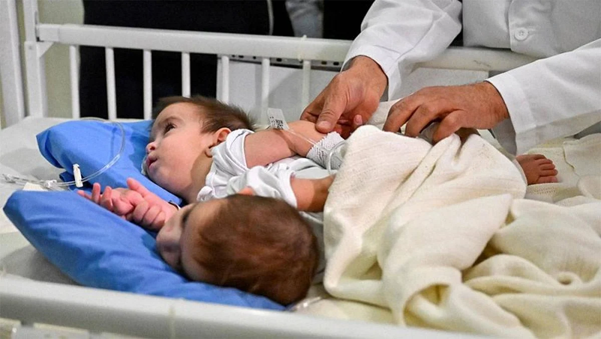 عملية فصل التوأم العراقي "علي وعمر".. في المراحل الأخيرة من المرحلة الرابعة