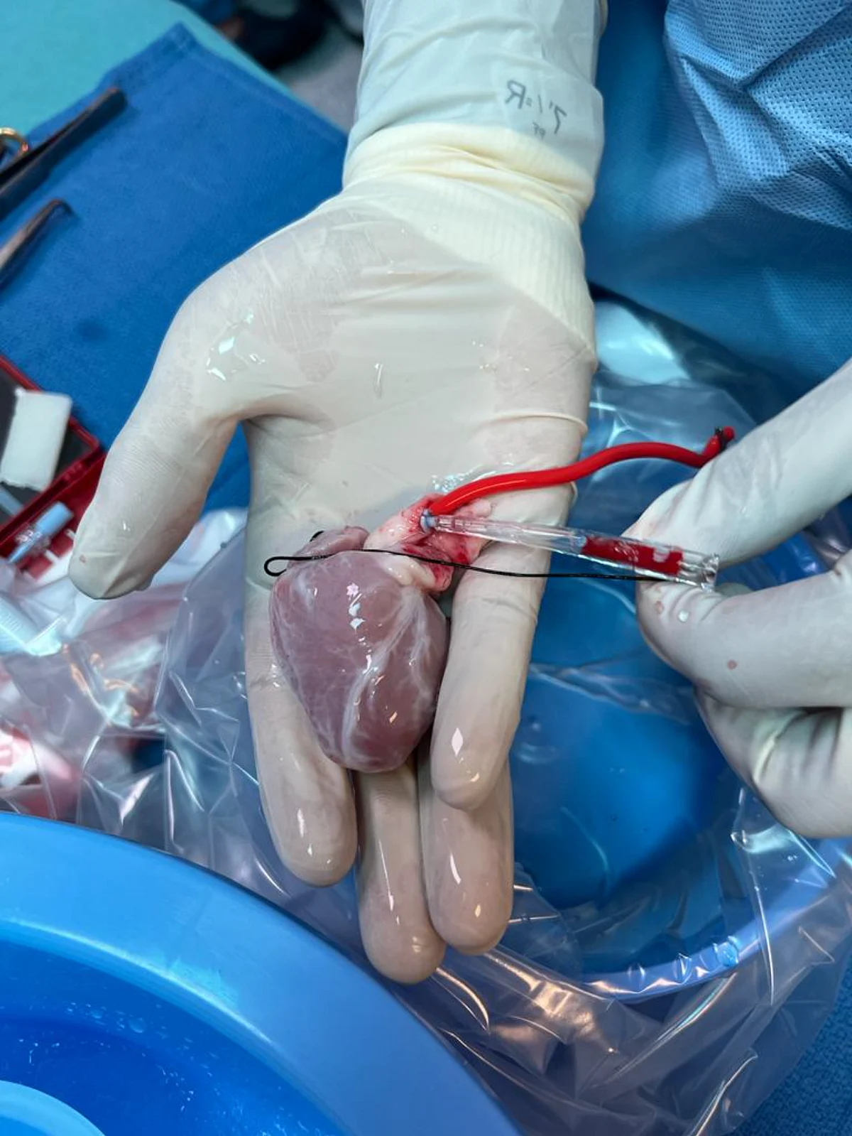 زراعة قلبين لطفلتين إحداهما لم تتجاوز شهرها الثامن