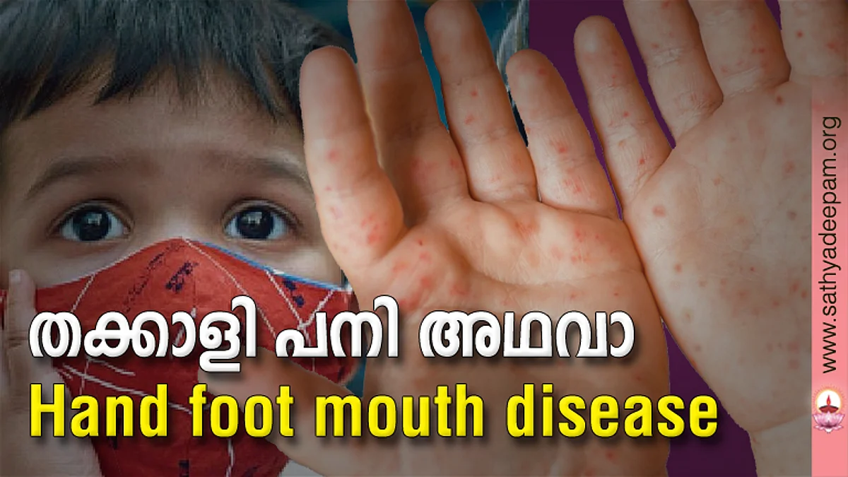 തക്കാളി പനി അഥവാ Hand foot mouth disease