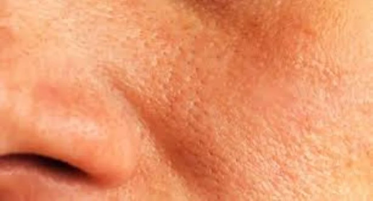 Pollution has Increased Skin Problems in Delhi