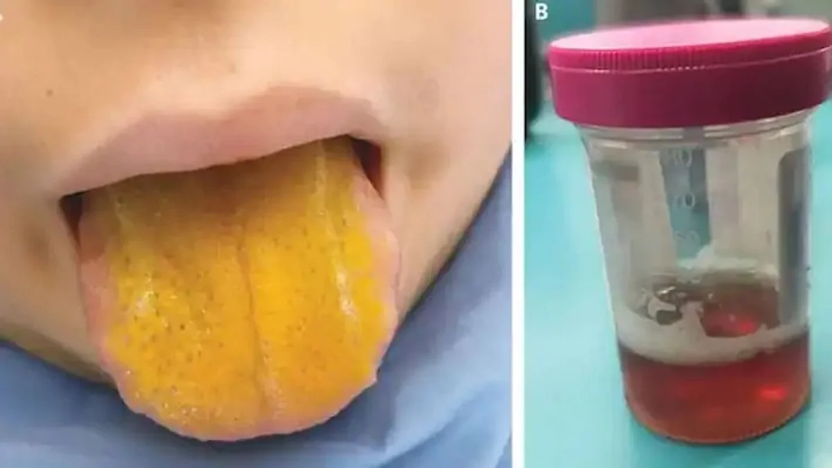 Rare Autoimmune Disorder Case in Canada, 12-Year-Old Boy Tongue Turns Yellow