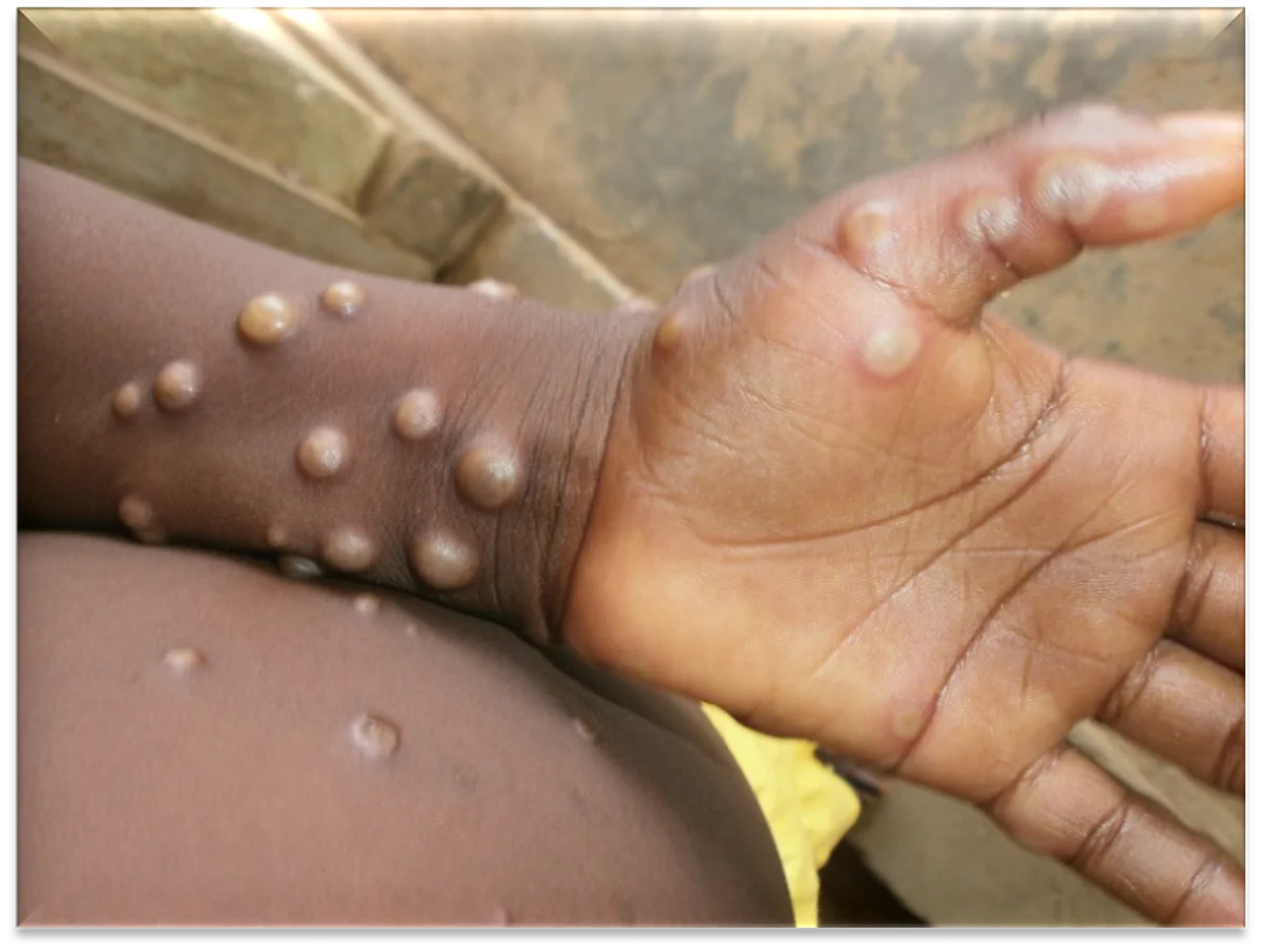 Monkeypox: केरल के बाद अब दिल्ली में भी मिला केस