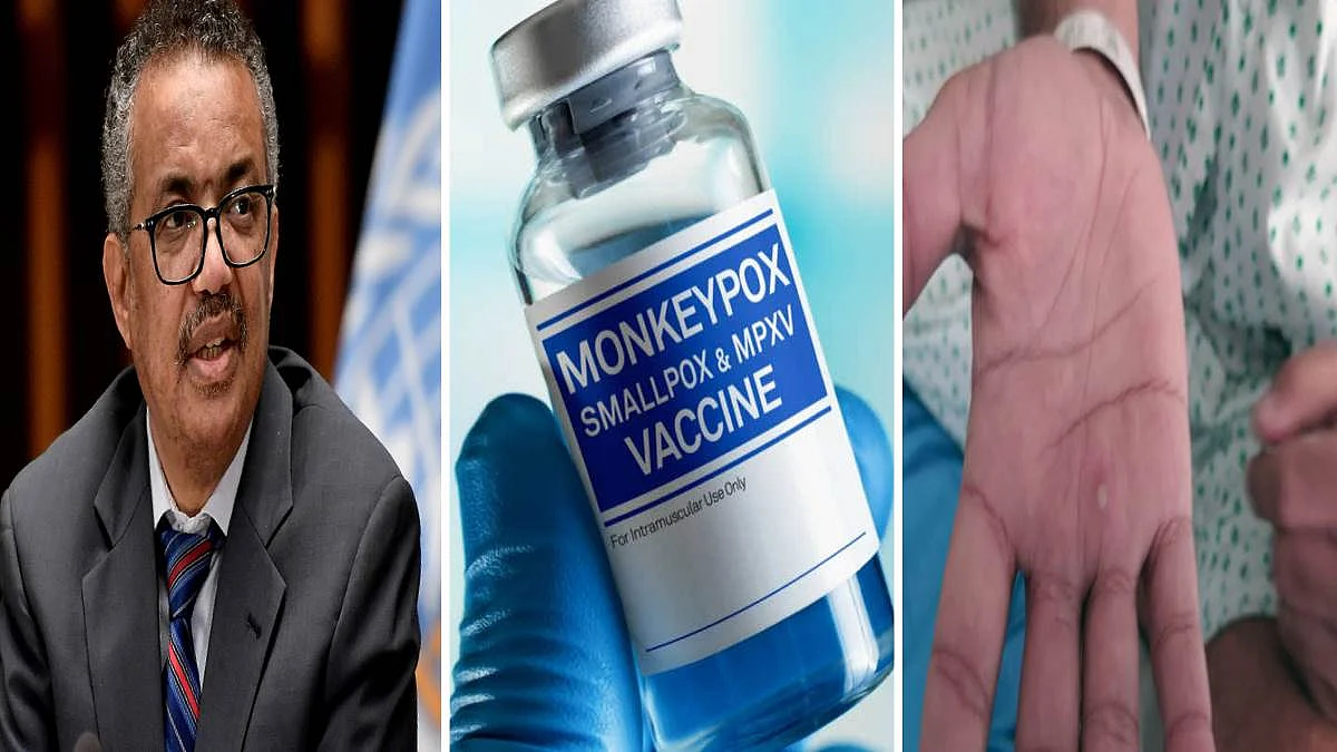 MVA-BN Vaccine : US, Canada और EU ने दी मंकीपाक्स वैक्सीन को मंजूरी