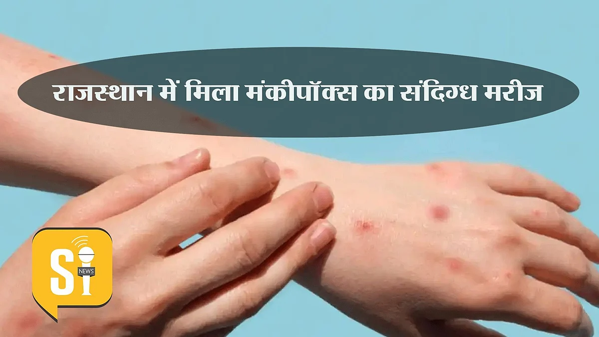 राहत की बात : प्रदेश में मिले मंकीपॉक्स के संदिग्ध मरीज की रिपोर्ट आई नेगेटिव