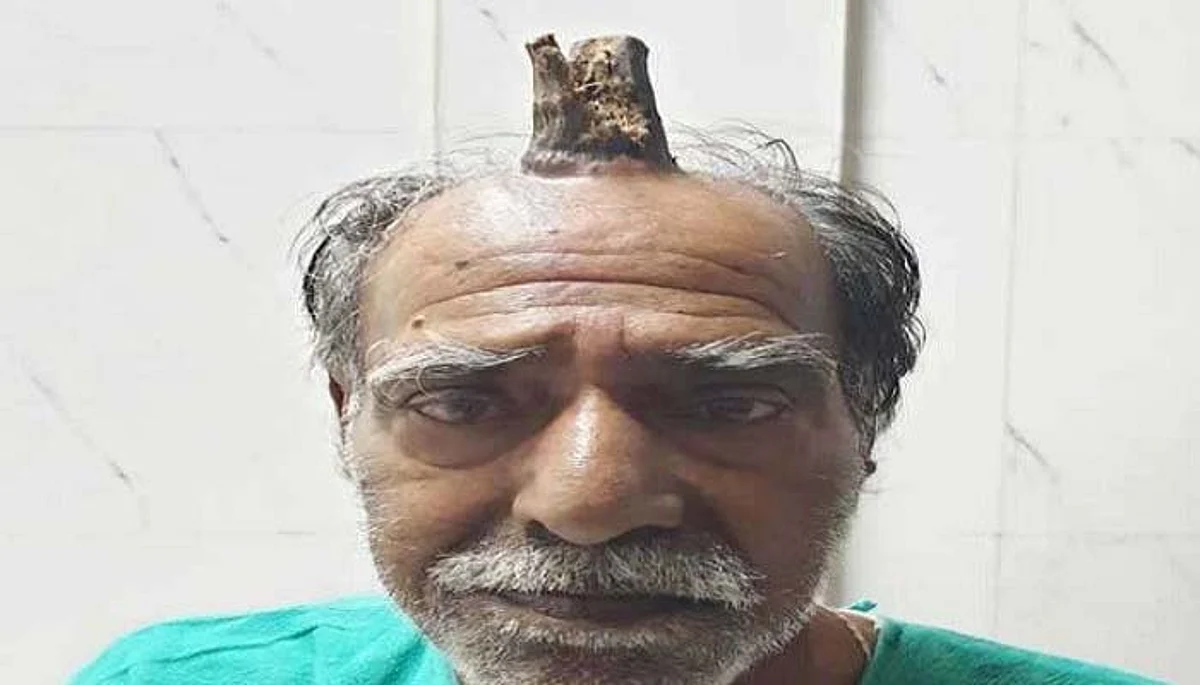 इंसान के सिर पर उगे सींग, जानिए पूरी घटना…