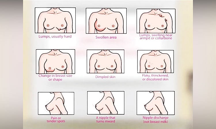 Breast Cancer: Fighting the enemy - Early detection is the key (2nd of 3 parts) - Vimarsana News