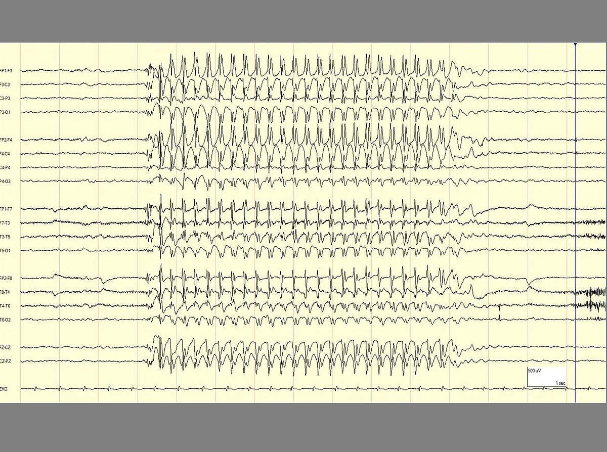 The EEG, a monitor of brain activity, during a seizure. In the left and right corners of the EEG tracing is the normal functioning of the brain. In the center is the rhythmic activity that characterizes a seizure. (www. epilepsydiagnosis.org)