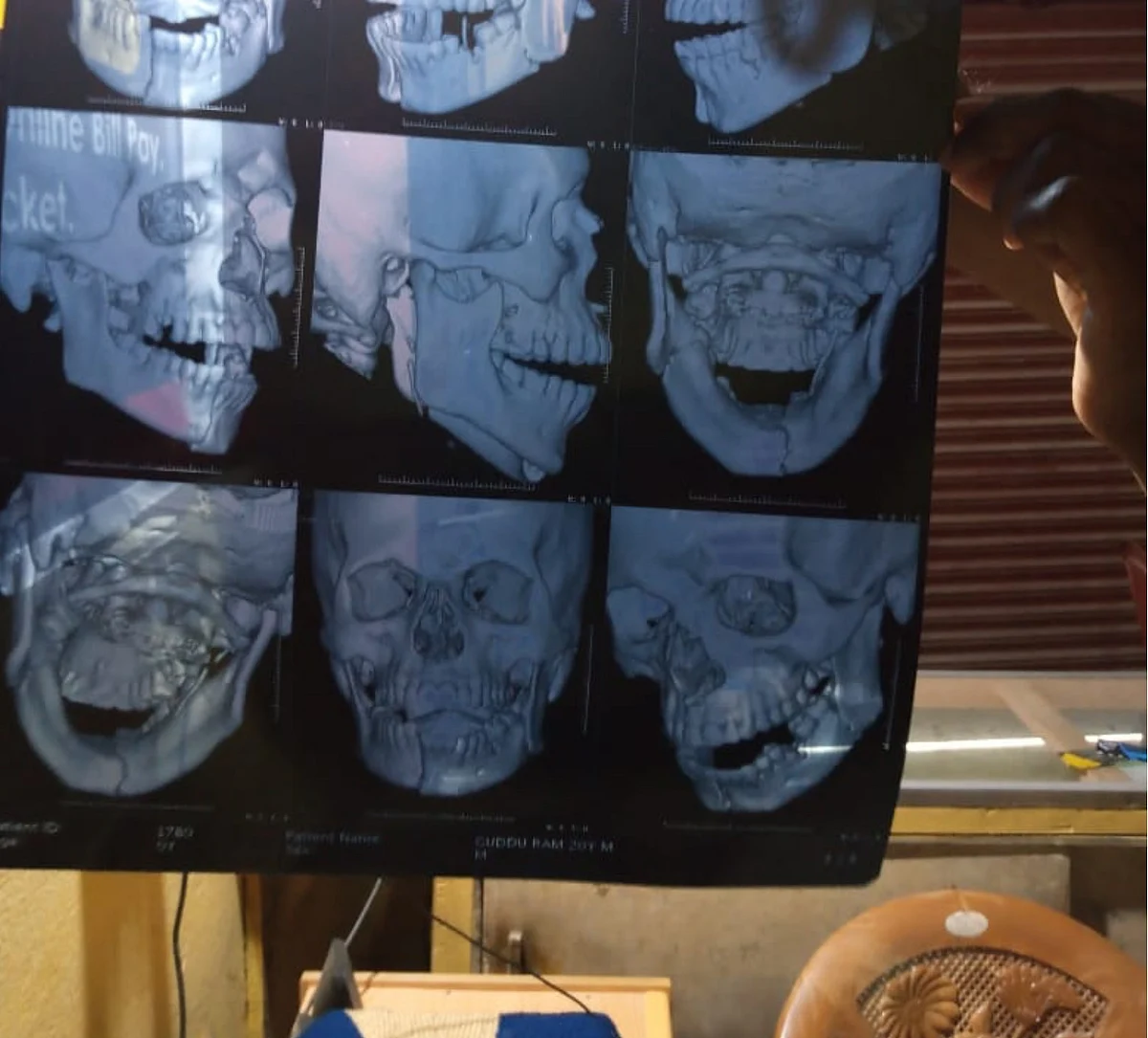 X-Ray report of Guddu/picture shared by Birendra Ram