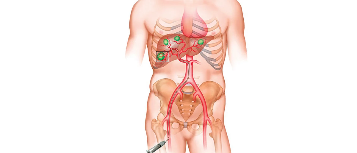 Sahyadri Hospitals conducts 100th liver transplant op
