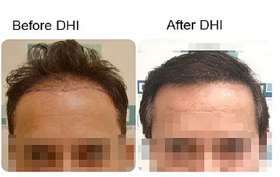 Natural, fair density result from a female hair transplant case Natural, fair density result from a female hair transplant case