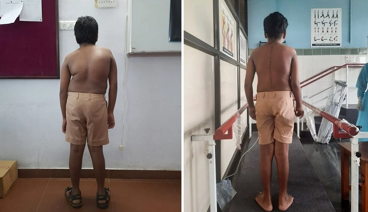 ജിത്തു ആദ്യമായി നിവര്ന്നു നിന്നു, താങ്ങായത് സര്ക്കാര് മെഡിക്കല് കോളേജിലെ സൗജന്യ നട്ടെല്ല് നിവര്ത്തല് ശസ്ത്രക്രിയ