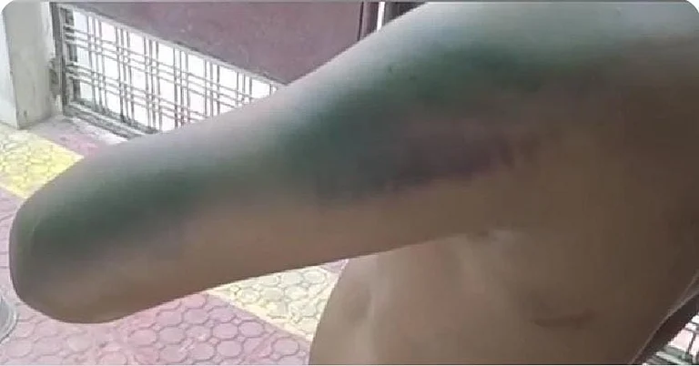 Dalit teenager's hand turned blue after beating in Mahoba.