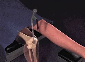 Surgeons break the leg bone into two and then implant an external device which pulls the bone apart very slowly, about one millimeter a day. New bones, nerves, arteries, muscles and tissues grow in the artificially created gap (Photo: YouTube/<a href="https://www.youtube.com/channel/UCar-cc8qD_4aOyCh6DkQ-LA">Height Lengthening</a>)