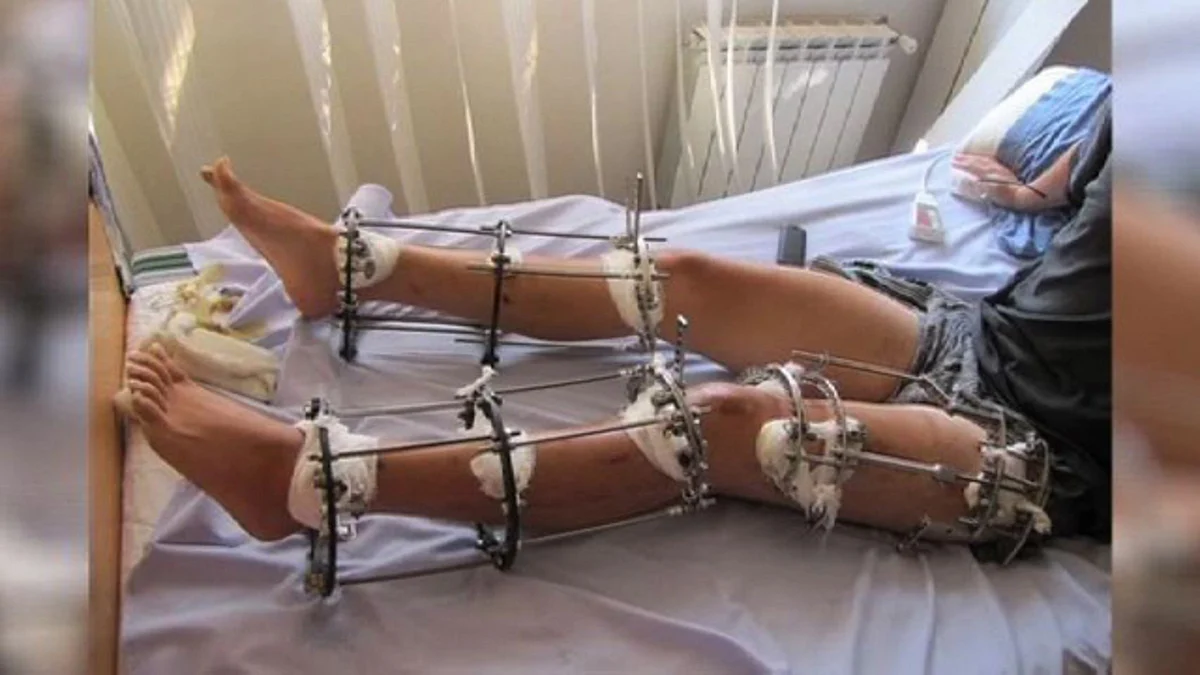 Nine out of ten people who opt for the surgery in India are men (Photo courtesy: <a href="http://www.odditycentral.com/news/getting-your-legs-broken-for-a-few-extra-inches-a-growing-trend-in-the-world-of-cosmetic-surgery.html">odditycentral</a>)