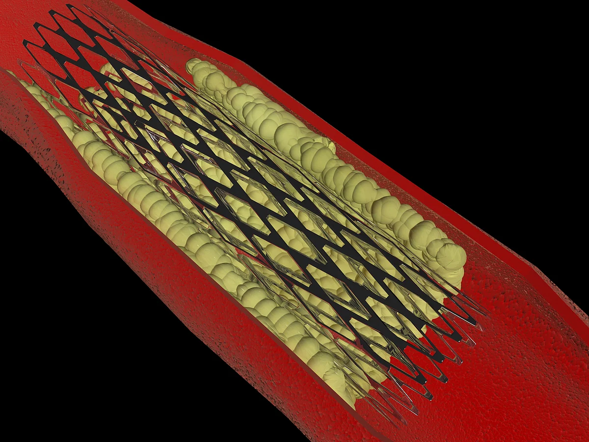 A stent holding up an artery. (Photo: iStock)