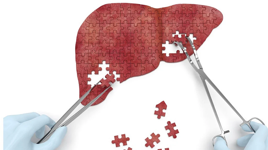 A liver transplant at 5 months.
