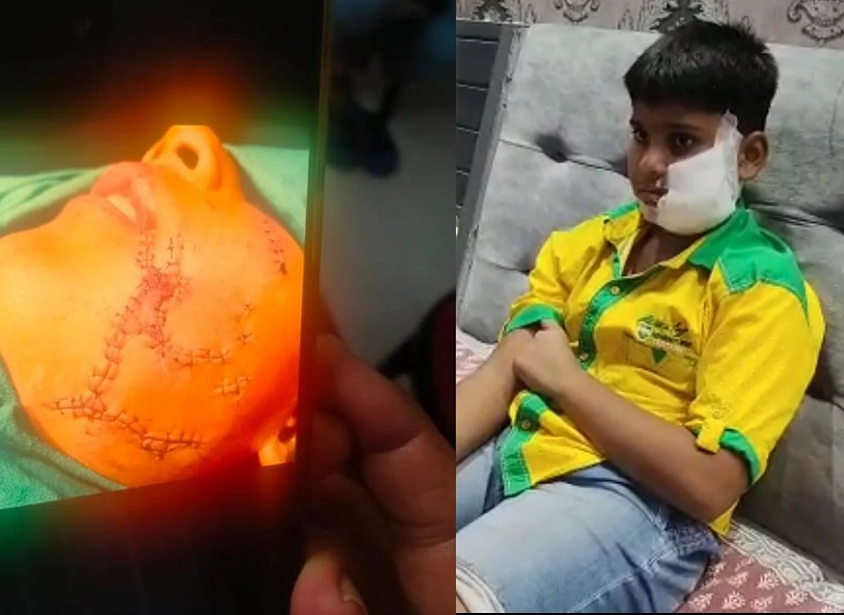 गाजियाबाद: पिटबुल डॉग का खौफनाक अटैक, मासूम के गाल को चीर दिया, आए 150 से ज्यादा टांके