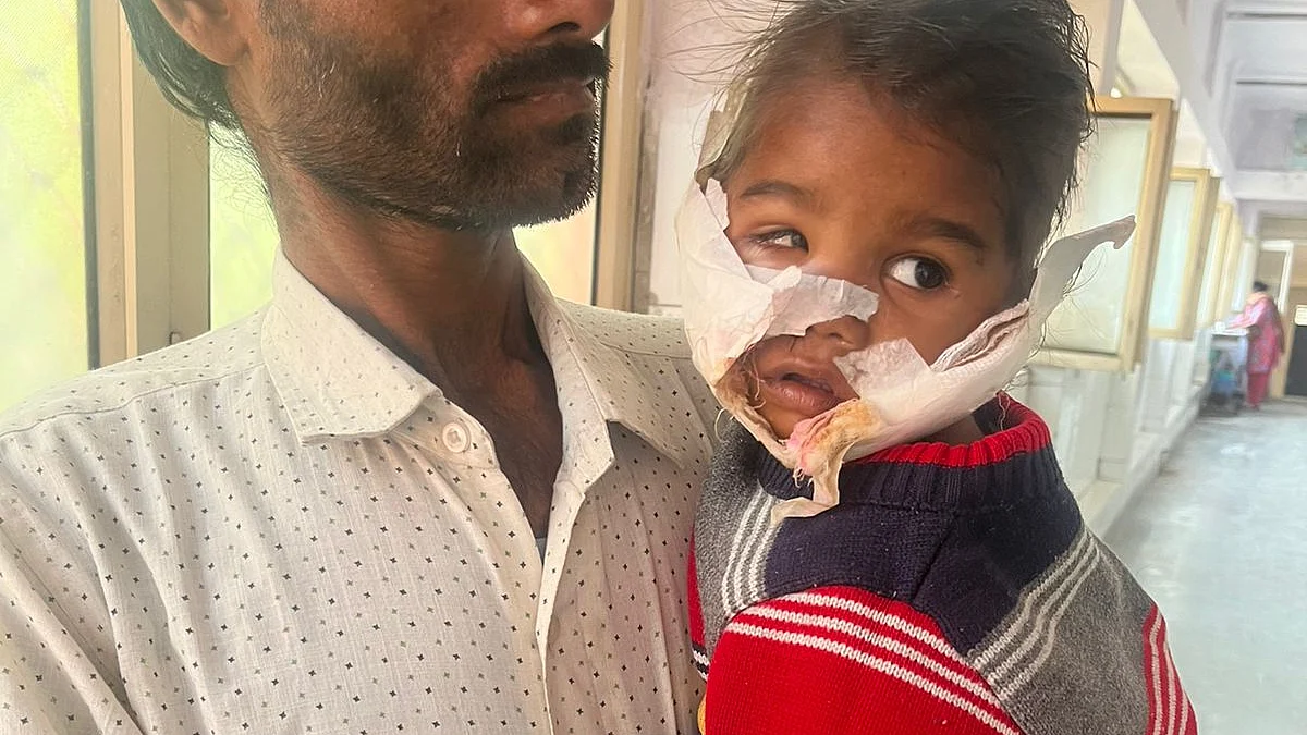 गाजियाबाद: सवा साल की बच्ची को कुत्ते ने किया लहुलुहान, चेहरे पर आए 70 टांके, हुई सर्जरी