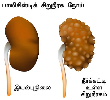 சிறுநீரகம் காப்போம்!