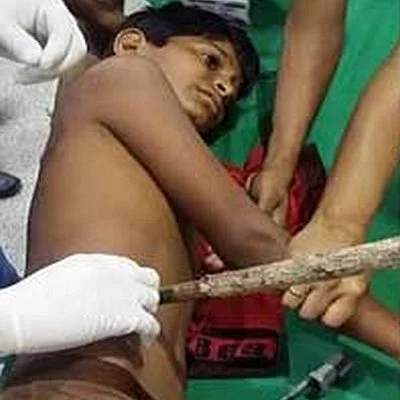 விளையாடும்போது சிறுவனின் வயிற்றை துளைத்து உள்ளே சென்றது மூங்கில் குச்சி!