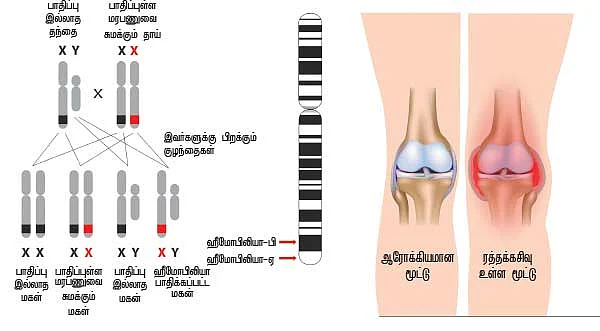 ஆண்களைப் பாதிக்கும் ஹீமோபிலியா
