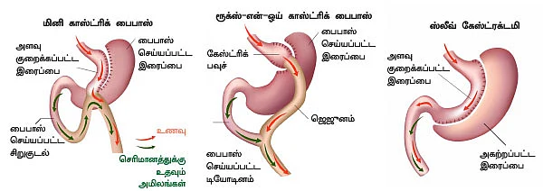 உடல்பருமன் அறுவைசிகிச்சை அழகா? ஆபத்தா?
