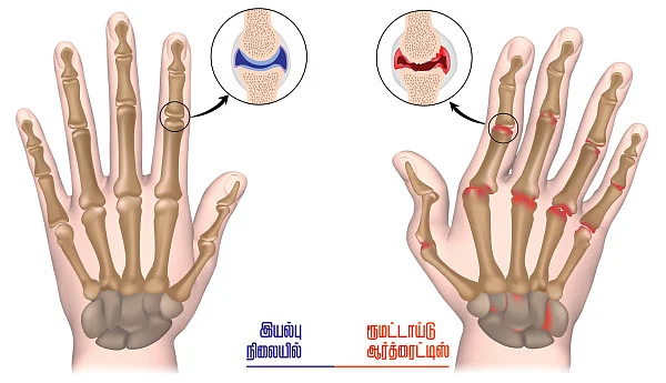 அலர்ஜியை அறிவோம் - 17