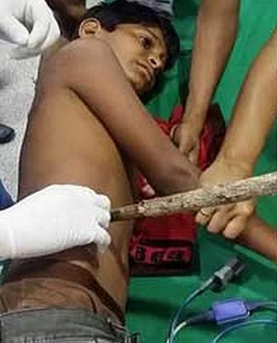 விளையாடும்போது சிறுவனின் வயிற்றை துளைத்து உள்ளே சென்றது மூங்கில் குச்சி!