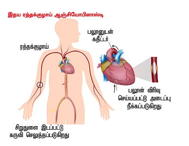சிறிய துளை பெரிய சிகிச்சை!