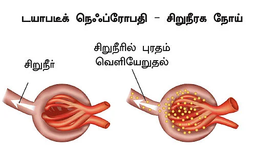 சிறுநீரகம் காப்போம்!