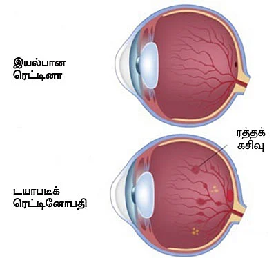 டயாபடீஸ் ரகசியங்களும்... தீர்வும்...