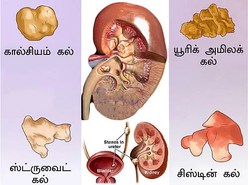 சிறுநீரகம் காப்போம்!