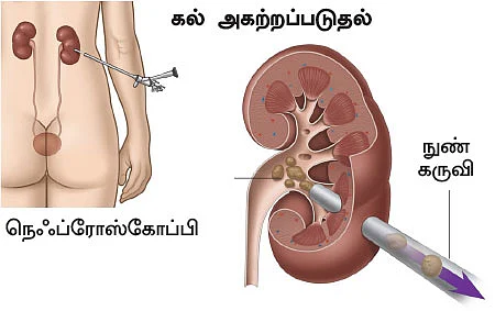 சிறுநீரகம் காப்போம்!