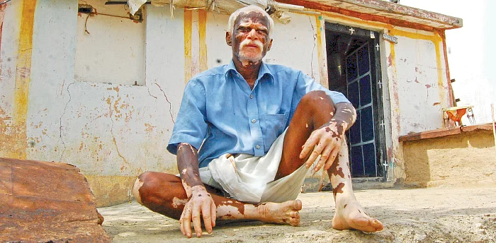 “வெண்புள்ளிக்காக வேலையைப் பறிப்பதா?”