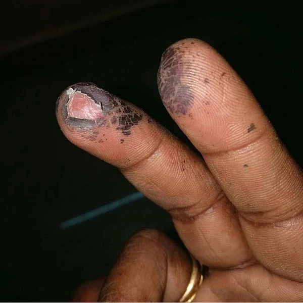 வாக்கு மையால் விரல்களில் புண்! - தேர்தல் ஆணையத்தின் மீது கடுப்பில் இருக்கும் பணியாளர்கள்