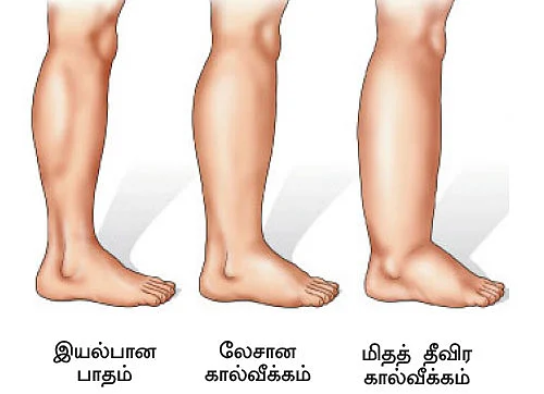 சிறுநீரகம் காப்போம்!
